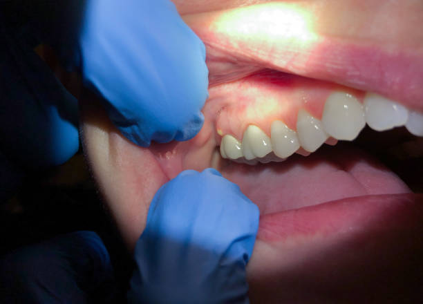 Best Emergency Wisdom Teeth Removal in Camden, AR