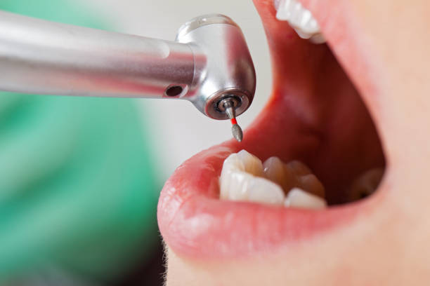 Best Emergency Tooth Extraction in Camden, AR